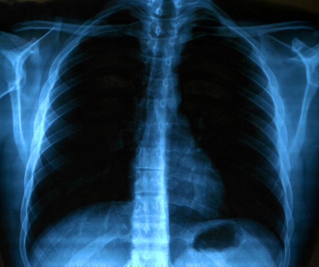 healthy chest x ray example