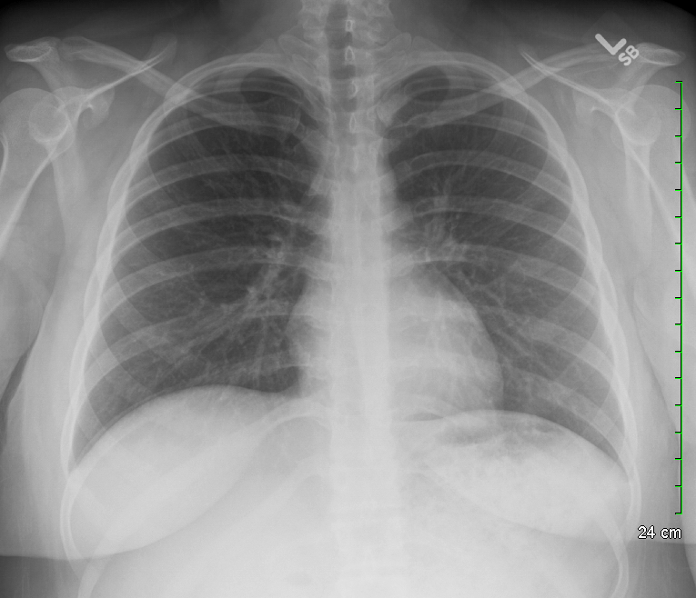 healthy chest x ray example